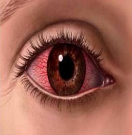 کمک های اولیه - جسم خارجی در چشم